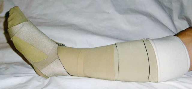 Compression Sleeves Treating Lymphedema, Edema, DVT & Hand Pain