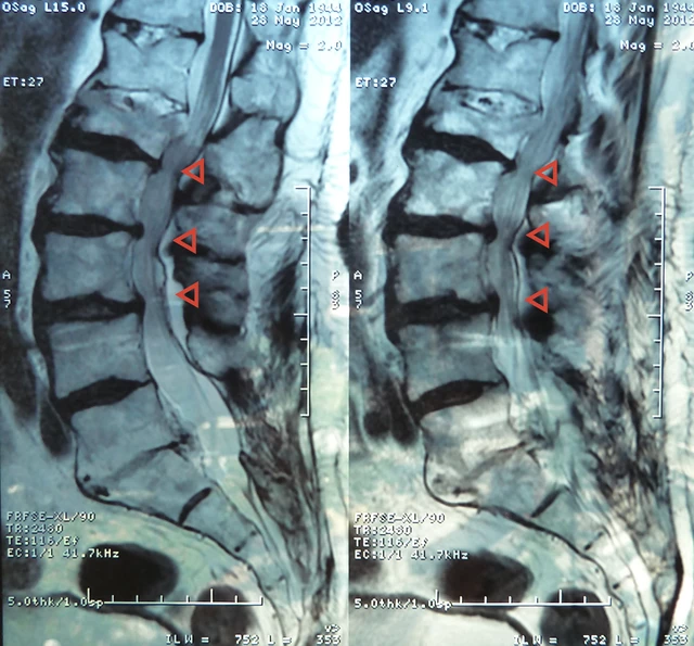 Lumbar spinal stenosis - Wikipedia