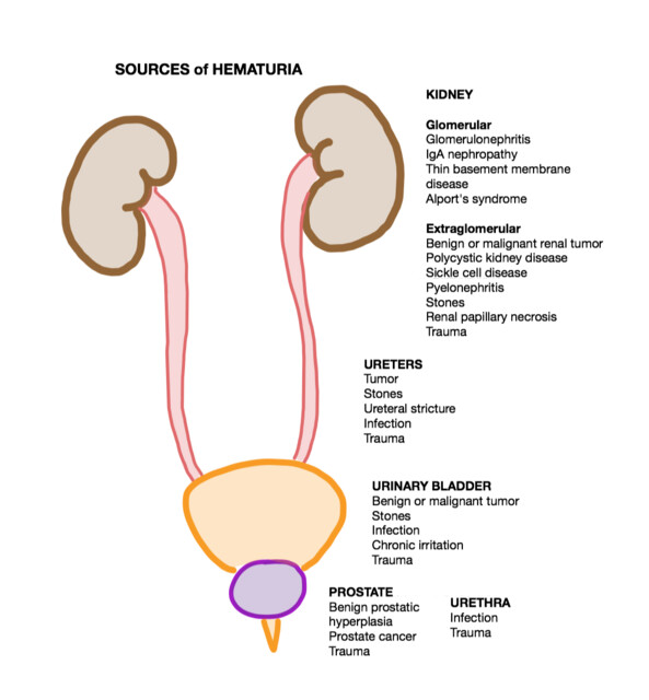 Glomerulonephritis Urine Specific Gravity