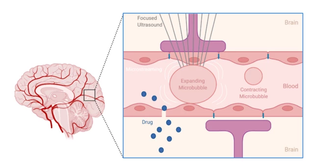 How cancer vesicles breach the blood-brain barrier