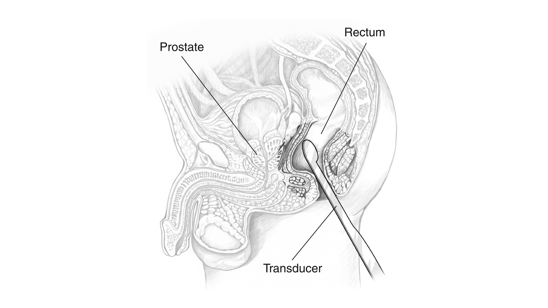 Prostate Ultrasound Why Is It Done And What The Results Mean Storymd