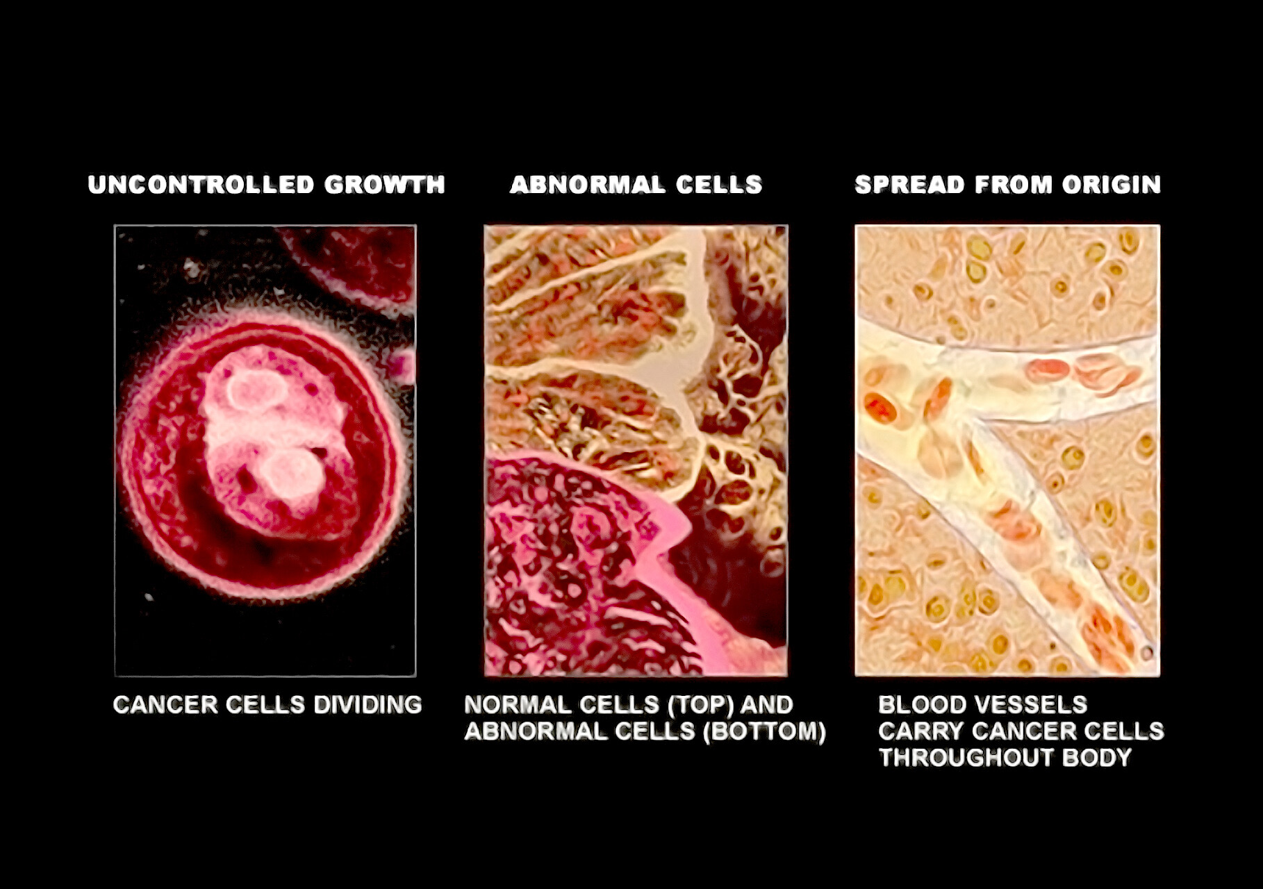 cancer cell vs normal cell microscope