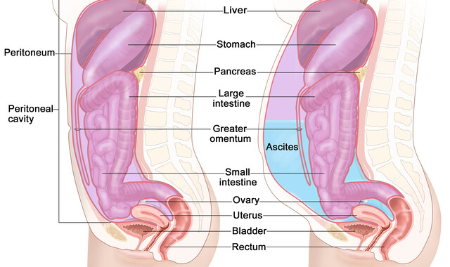 Is Ascites Peritoneal Fluid