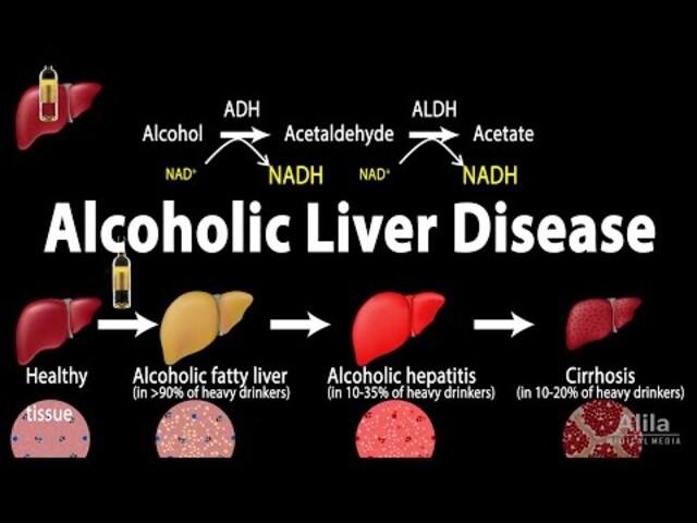 What Is Alcoholic Fatty Liver Disease? - StoryMD