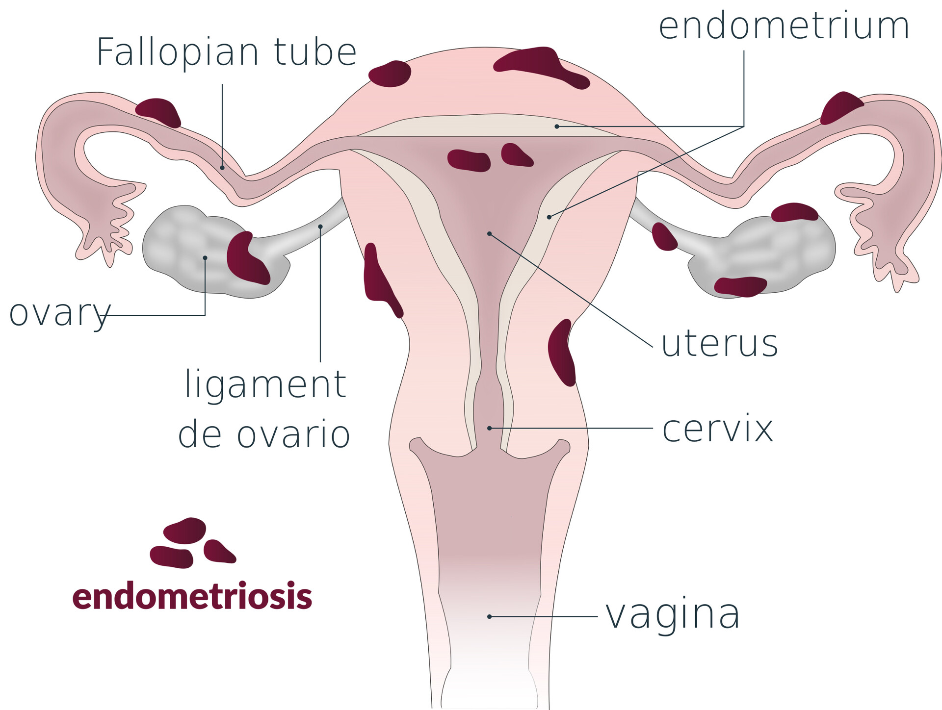 Endometriosis Symptoms and Causes