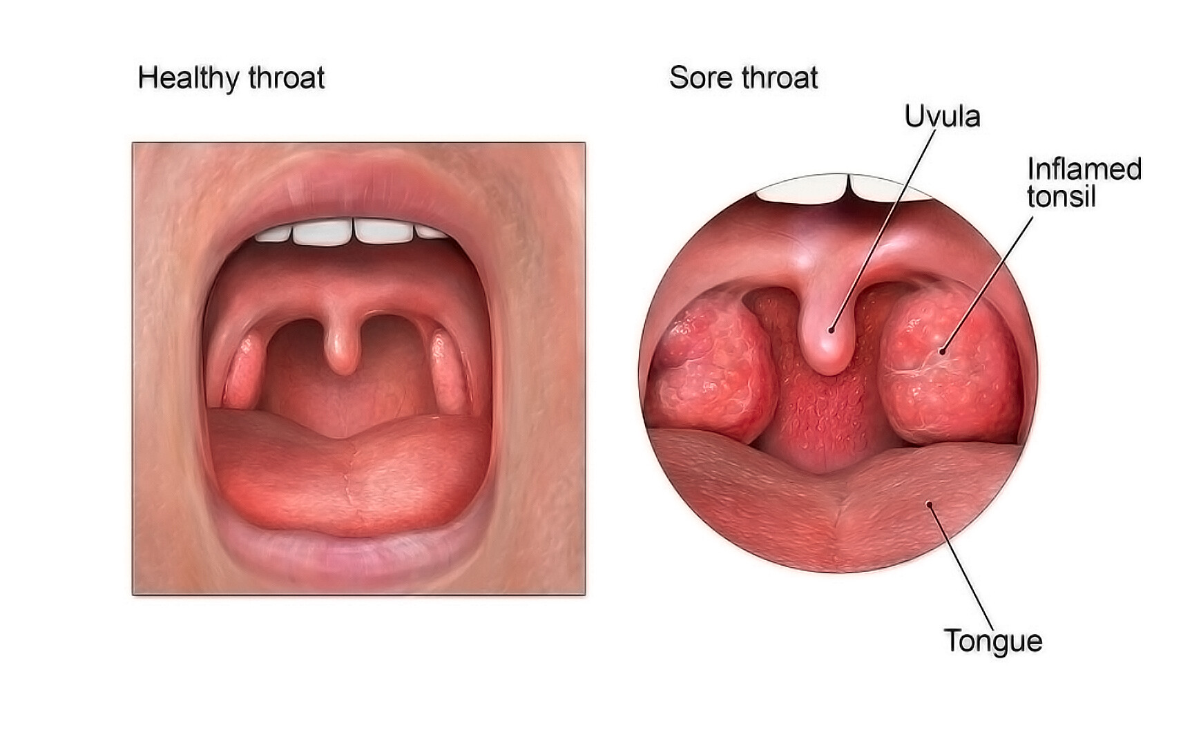 allergy throat bumps
