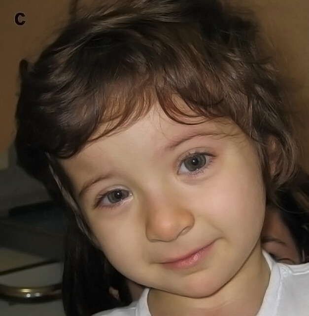 SciELO - Brasil - Prosthetic rehabilitation of a child with Rubinstein-Taybi  Syndrome after dental trauma: case report Prosthetic rehabilitation of a  child with Rubinstein-Taybi Syndrome after dental trauma: case report