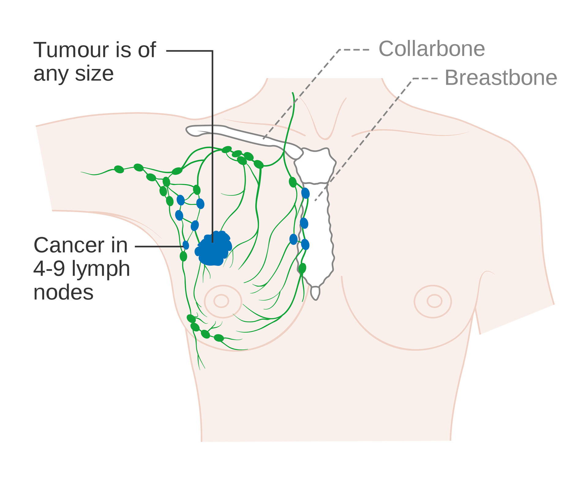 What Are the Symptoms of Breast Cancer? - StoryMD