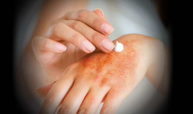 Itchy, Scaley, and Flakey: What It’s Like Living with Psoriasis - StoryMD