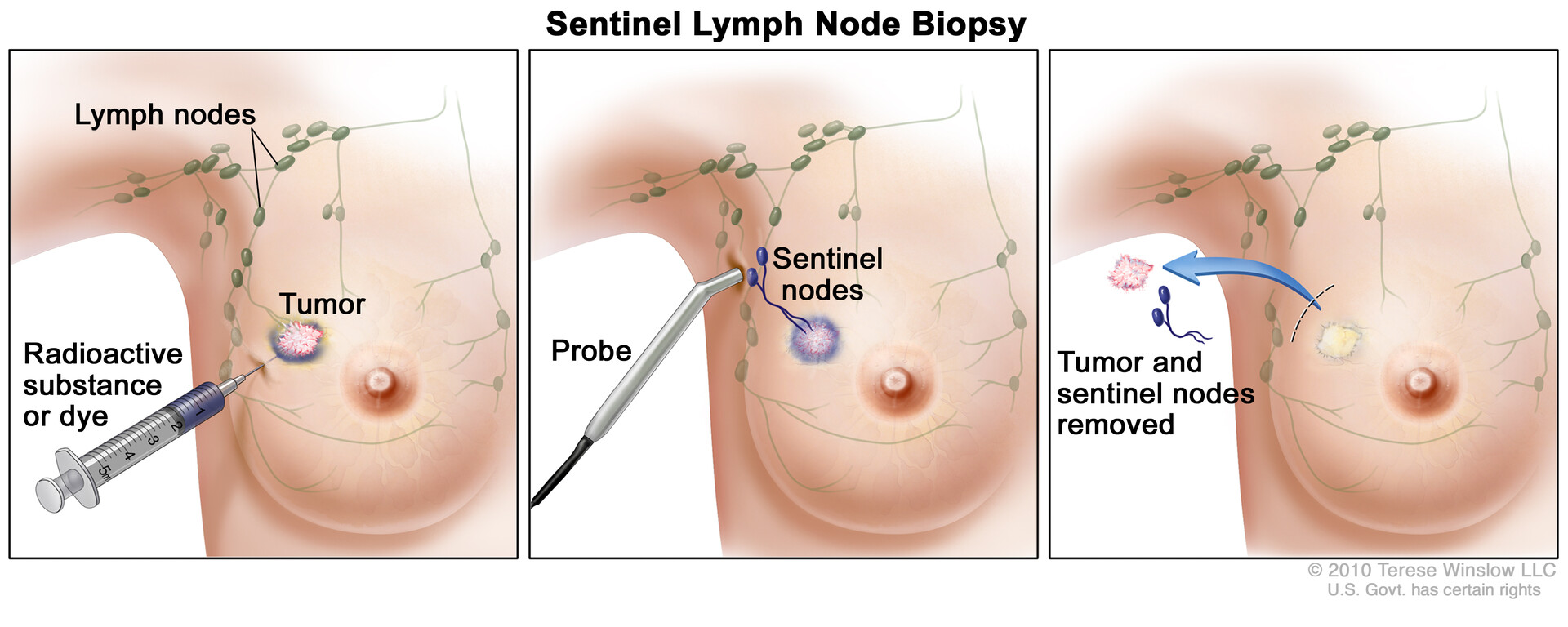 Breast Cancer - StoryMD